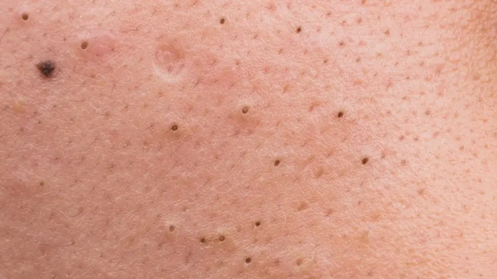 Blackheads